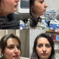 بلفاروپلاستی ساکشن غبغب لیزر