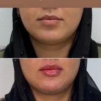 جشنواره ژل لب روسی و بوتاکس|خدمات آرایشگری و زیبایی|فردیس, شهرک ارم|دیوار