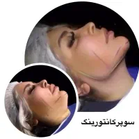آف ۵۰%ساکشن غبغب تکنیک وی لاین وبلفارو پلاستی چشم