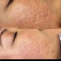 خال برداری کاملا بهداشتی وباوسایل یک بار مصرف|خدمات آرایشگری و زیبایی|قم, امامزاده ابراهیم|دیوار