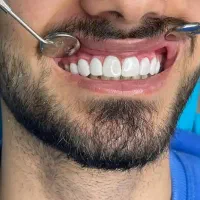 دندانپزشکی عصبکشی و ترمیم بابهترین موادوکیفیت