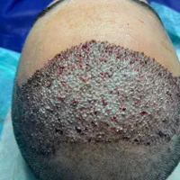 کاشت مو طبیعی با جدید ترین روشfitوسوپرfut|خدمات آرایشگری و زیبایی|اهواز, زیتون کارمندی|دیوار