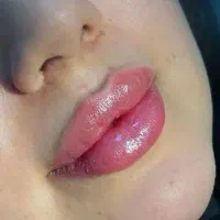 تخفیف ویژه ژل و فیلر|خدمات آرایشگری و زیبایی|گلبهار, شهر جدید گلبهار|دیوار