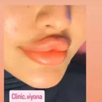 تخفیفات پاییزه   ژل ، بوتاکس ، فیلر،جوانسازی پوست|خدمات آرایشگری و زیبایی|تهران, نیروی هوایی (پیروزی)|دیوار