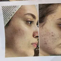 آموزش فیشال و پاکسازی|خدمات آرایشگری و زیبایی|اصفهان, چشمه باقرخان|دیوار