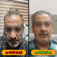 جشنواره یلدایی کاشت تخصصی مو و ابرو (شرایط اقساط)|خدمات آرایشگری و زیبایی|شیراز, خلدبرین|دیوار