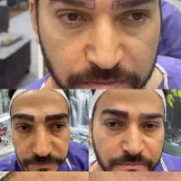 کاشت مو ابرو لیزر ژل بوتاکس مزو واکسن زگیل تناسلی|خدمات آرایشگری و زیبایی|اندیشه, اندیشه فاز ۱|دیوار