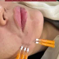 هایفوتراپی صورت ،رفع غبغب ،لاغری امبدینگ،خالبرداری|خدمات آرایشگری و زیبایی|شهر بابک, |دیوار