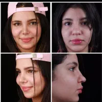 عمل جراحی بینی فقط 28.900 درکرج بدون تامپون(ENT)|خدمات آرایشگری و زیبایی|کرج, جهان‌شهر|دیوار