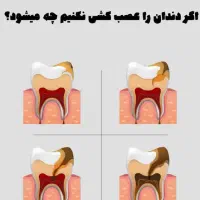 عصب کشی دندان کرسی پایین با هزینه کم