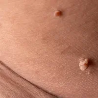 اگر زگیل دارید این آگهی برای شماست|خدمات زیبایی و سلامت|تهران, والفجر|دیوار