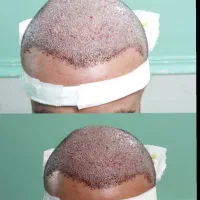 کاشت مو شیرازی فول تراکم