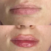 خدمات زیبایی صورت مزوتراپی بوتاکس فیلر|خدمات آرایشگری و زیبایی|شهریار, شهریار|دیوار