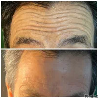مزوتراپی مو ،ژل،بوتاکس|خدمات زیبایی و سلامت|تهران, بلوار کشاورز|دیوار