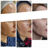 حذف دائمی کک مک گلسار رشت کلینیک