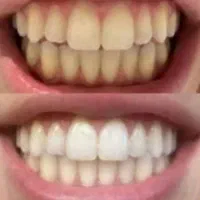 سفیدی واقعی زمانی خوبه که به مینای دندان آسیب نزنه