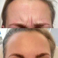 اموزش. بوتاکس فول فیس چشم گربه ای لیفت شقیقه|خدمات آرایشگری و زیبایی|خرم‌آباد, |دیوار