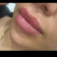 تزریق ژل و بوتاکس|خدمات آرایشگری و زیبایی|لامرد, |دیوار