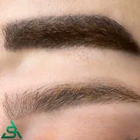 دستگاه لیزر کیوسوییچ|آرایشی، بهداشتی، درمانی|کرمان, |دیوار