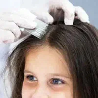 درمان قطعی شپش فقط در یک جلسه