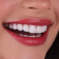 ایمپلنت در تبریز روکش ارتودنسی کامپوزیت