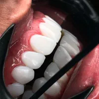 جشنواره کامپوزیت فکی چهار تومن