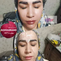 جشنواره ژل لب/فیلرلب/بوتاکس/آنزیم/هایفو توسط پزشک|خدمات زیبایی و سلامت|مشهد, هدایت|دیوار