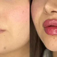 ژل و بوتاکس و مزو|خدمات آرایشگری و زیبایی|کرج, کیانمهر|دیوار