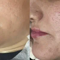 هایفوتراپی و فشیال پوست کره ای|خدمات آرایشگری و زیبایی|یزد, |دیوار