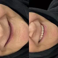 دندان مصنوعی با نظارت دکتر متخصص با بهترین هزینه