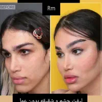 لیفت فول فیس صورت و شقیقه بدون عمل جراحی