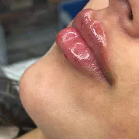 ژل،بوتاکس،چربی،پاک کردن تتو|خدمات زیبایی و سلامت|کرمانشاه, |دیوار