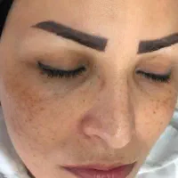 برداشت انواع لک.کک ومک.خال.زگیل