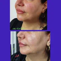 جوانسازی قوی بدون مواد|خدمات آرایشگری و زیبایی|رشت, کاکتوس|دیوار