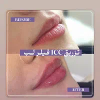 فیلر لب ۱/۶۰۰/تاپایان این هفته|خدمات آرایشگری و زیبایی|رشت, کوی حسینی|دیوار