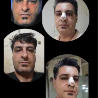 جراحی زیبایی بینی فقط با۲۹میلیون (تاپایان خردادماه