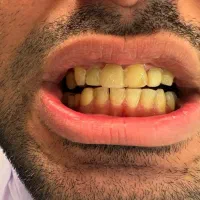 کامپوزیت دندان هر فک 5تومن|خدمات آرایشگری و زیبایی|محمدشهر, محمدشهر|دیوار