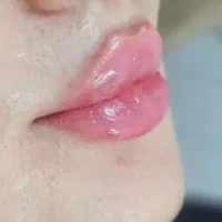 جشنواره فیلرو بوتاکس با قیمت باور نکردنی در مطب