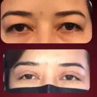 کاشت مو ابرو بلفاروپلاستی تخلیه غبغب توسط دکتر|خدمات زیبایی و سلامت|قم, زنبیل آباد|دیوار