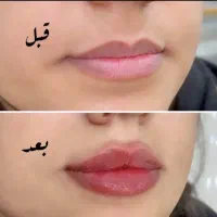 تزریق تخصصی ژل و بوتاکس|خدمات آرایشگری و زیبایی|سبزوار, کوی بهار|دیوار