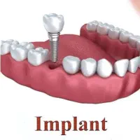 ایمپلنت دندان ۷۹۰۰ با ضمانت ۲۰ ساله