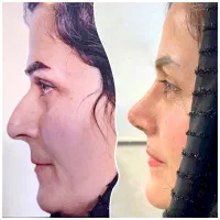 بوتاکس ژل  فیلر جراحی های زیبایی