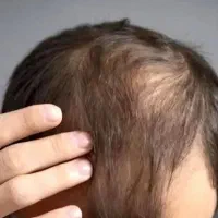 رشد مو به سرعت برق و نور