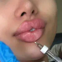 ژل/فیلر/فیشیال/پاکسازی/پوست ومولیزر|خدمات آرایشگری و زیبایی|کرج, گوهردشت|دیوار