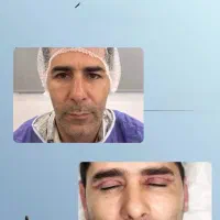 مدل جهت تزریق چربی/انجام بلفاروپلاستی|خدمات زیبایی و سلامت|تهران, شکوفه (عبدل آباد)|دیوار