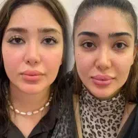 ژل و بوتاکس بیکینی ۴۵۰کانتورینگ ۹۵۰
