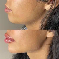 فیلر بوتاکس لیزر موهای زائد فیشال فشیال|خدمات آرایشگری و زیبایی|تهران, سبلان (لشگر)|دیوار