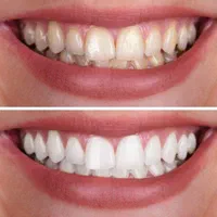 سفید کردن دندان|خدمات آرایشگری و زیبایی|رشت, دیلمان|دیوار