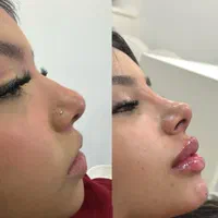 آنزیم ترکیبی بینی گوشتی،لیفت بینی،ژل لب،مزوتراپی|خدمات آرایشگری و زیبایی|تهران, سعادت‌آباد|دیوار