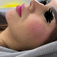 تزریق ژل و بوتاکس
